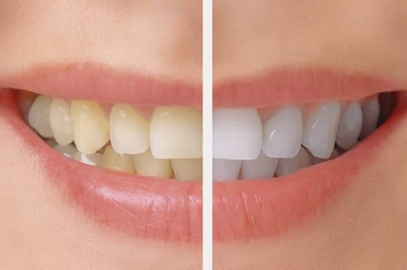 A teeth whitening before and after close up of a womans smile