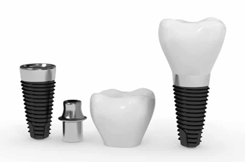 dental implants pasadena available in pasadena TX