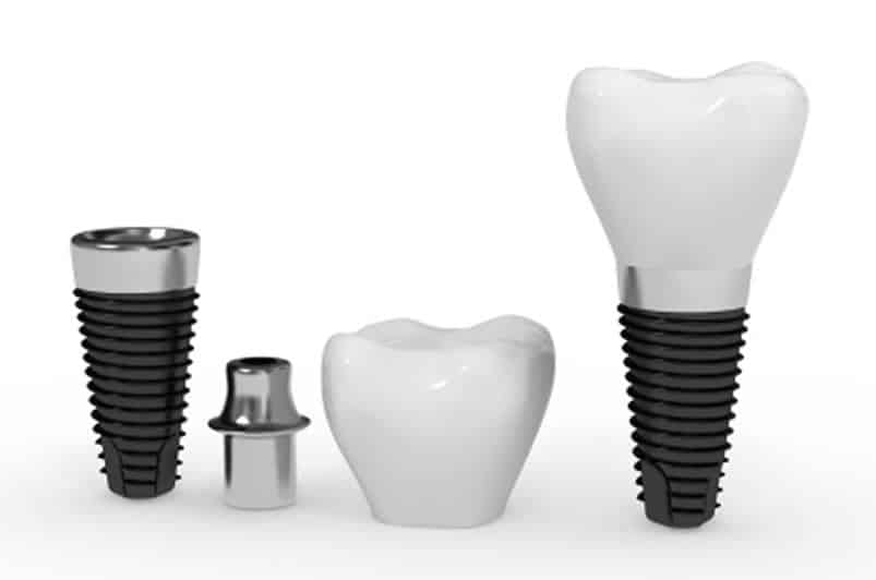 Dental Implants Pasadena TX