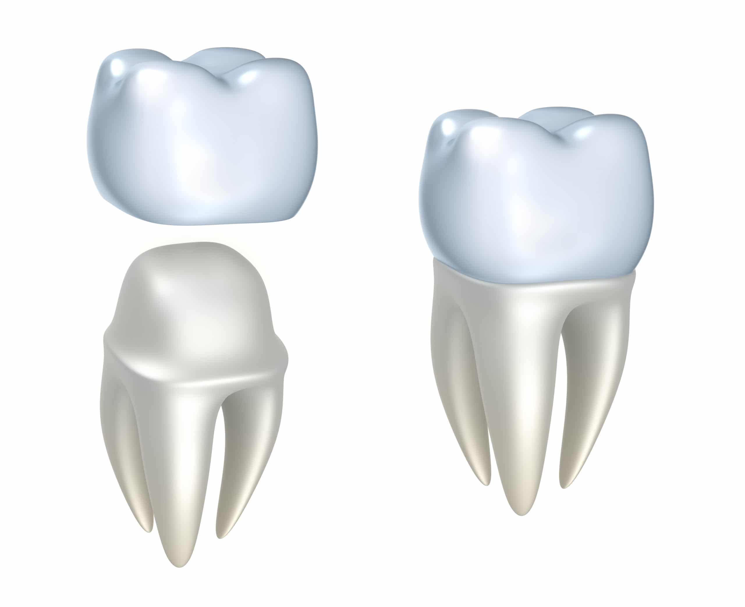 3D-rendered crown before and after being placed on tooth