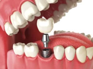 Titanium Teeth Anchors Pasadena TX