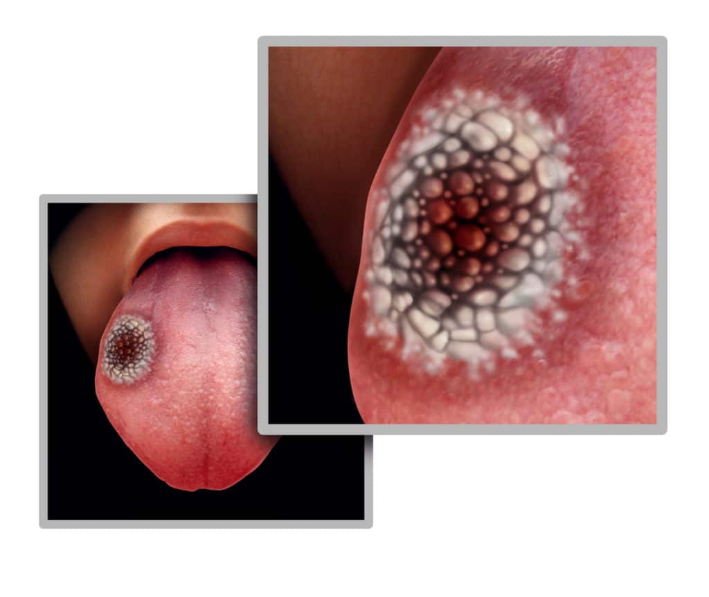 Tongue cancer medical concept or squamous cell carcinoma as malignant tumor disease in the mouth with 3D illustration elements.