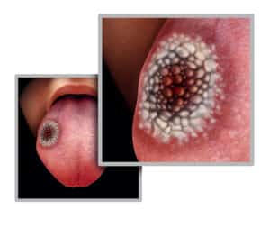 Oral Cancer Symptoms Pasadena TX