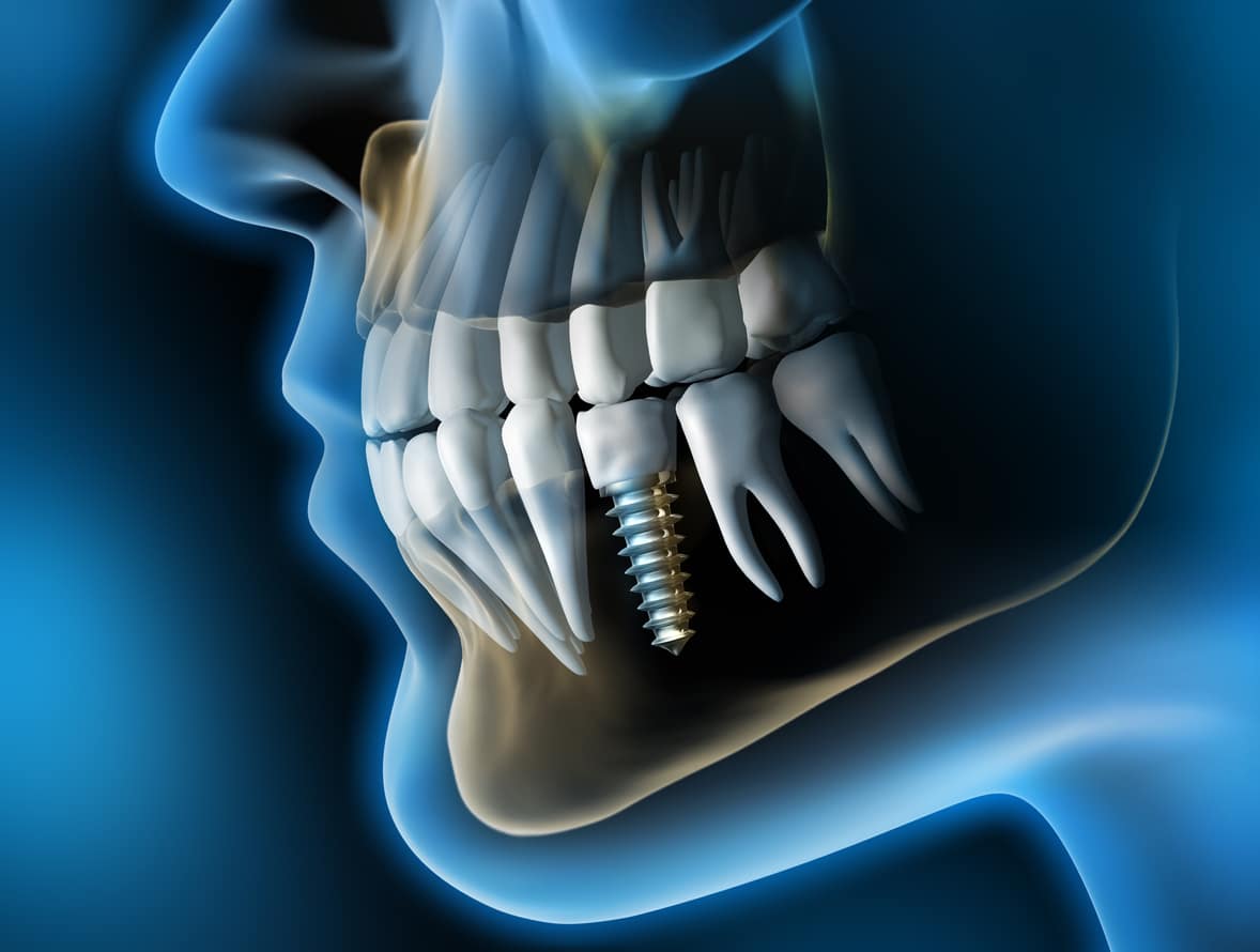 Teeth | Dental Implants